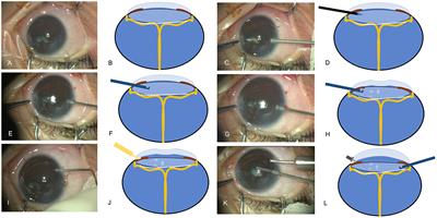 Dry-Lensectomy Assisted Lensectomy in the Management for End-Stage Familial Exudative Vitreoretinopathy Complicated With Anterior Segment Abnormalities